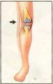 After MCL injury