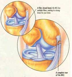 Impact injury to MCL