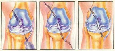 Reconstruction Arthroscopy