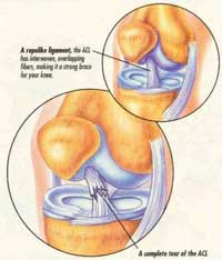 Torn from a twist (ACL)